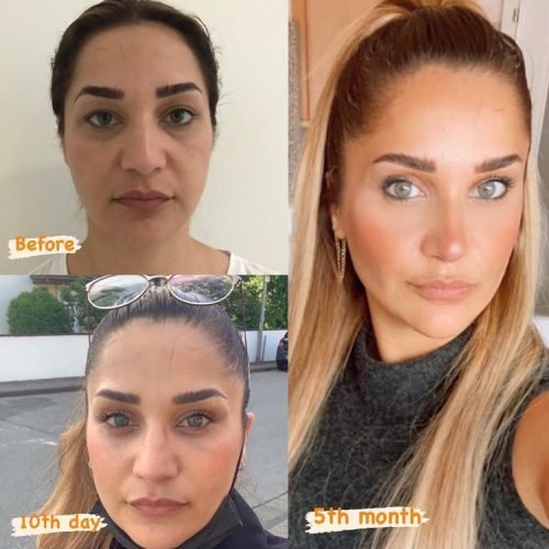 bichectomy-before-after