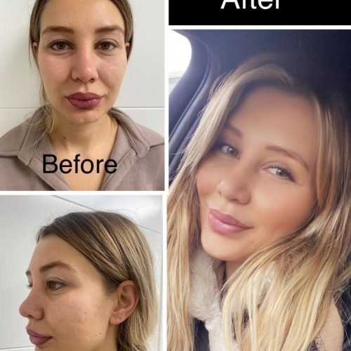 bichectomy-before-after-results