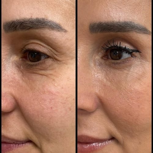 cateye-before-after-results