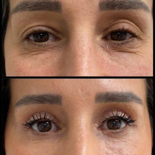 fox-eyes-before-after